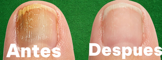 ✨ FungiKick – La Solución Rápida y Efectiva contra los Hongos en las Uñas ✨