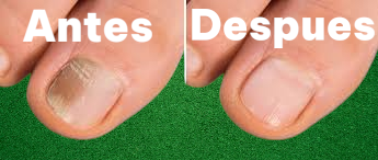 ✨ FungiKick – La Solución Rápida y Efectiva contra los Hongos en las Uñas ✨